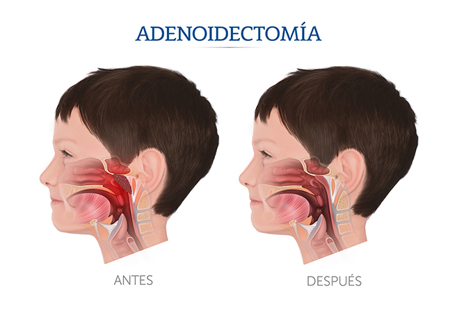Iustracin sobre la adenoidectoma