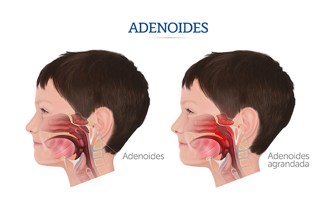 Ilustracin del lugar que ocupan las adenoides