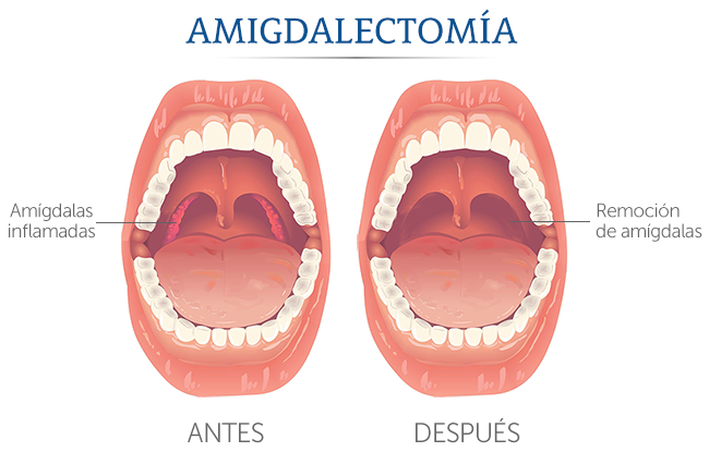 Ilustracin de dos bocas abiertas antes de la amigdalectoma y despus de la ciruga.